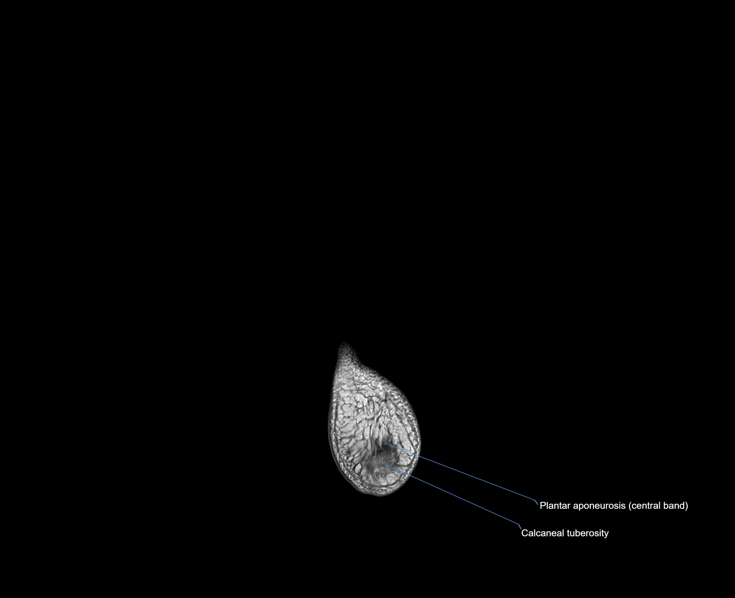 MRI foot coronal cross sectional anatomy 3T  radiology  image-img-00001-00034.webp